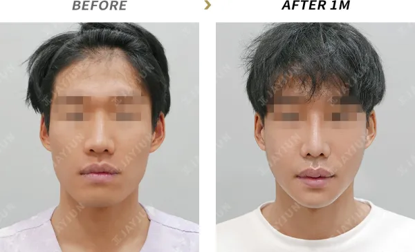 Before/After