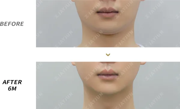 Before/After