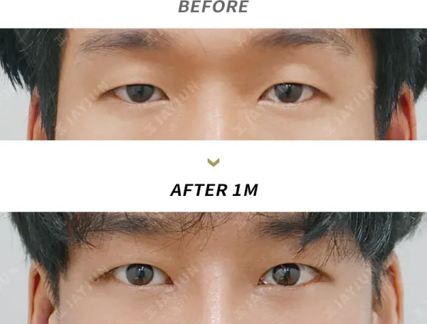 Before/After