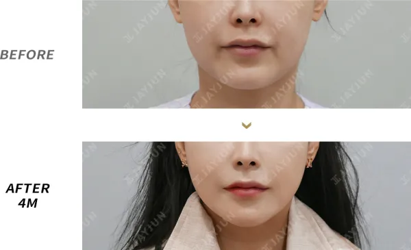 Before/After
