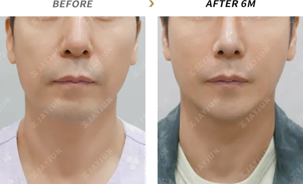 Before/After