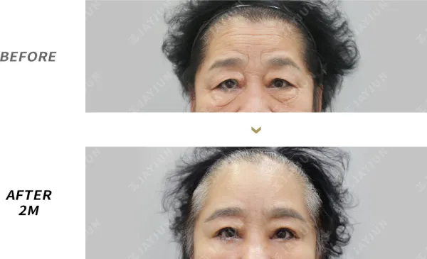 Before/After