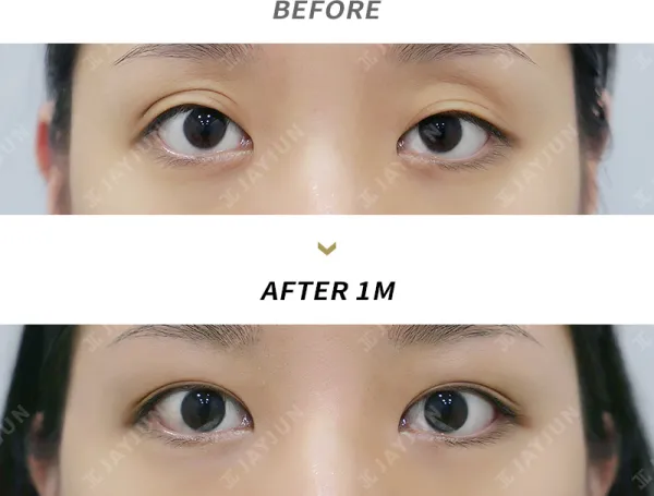Before/After