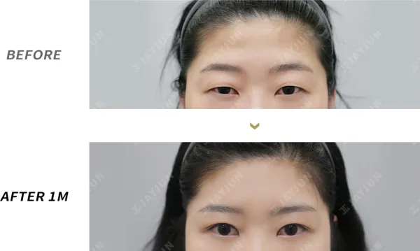 Before/After