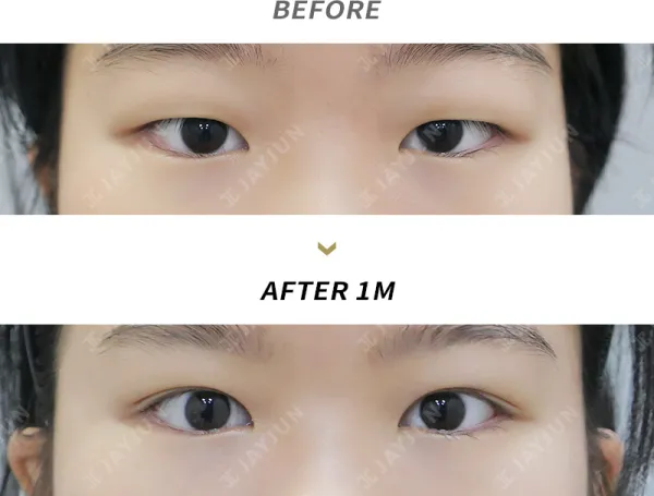 Before/After