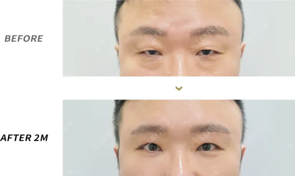 Before/After