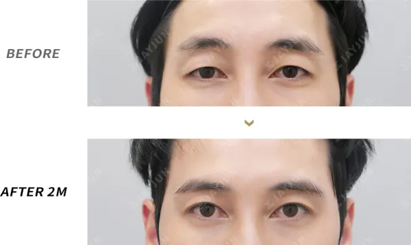 Before/After