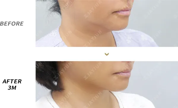 Before/After