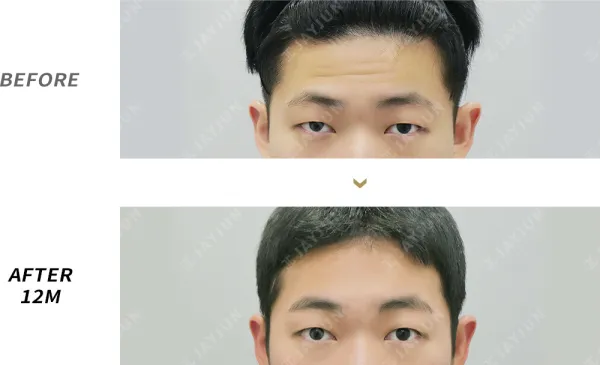 Before/After