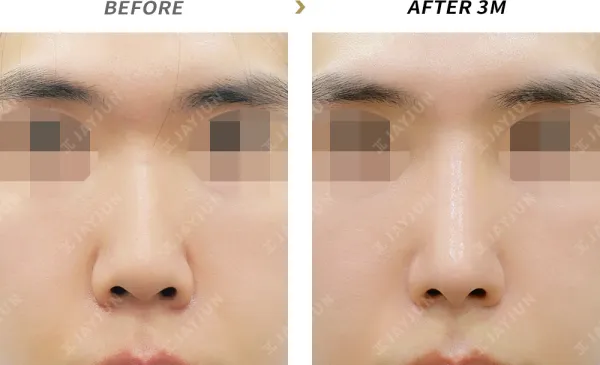 Before/After