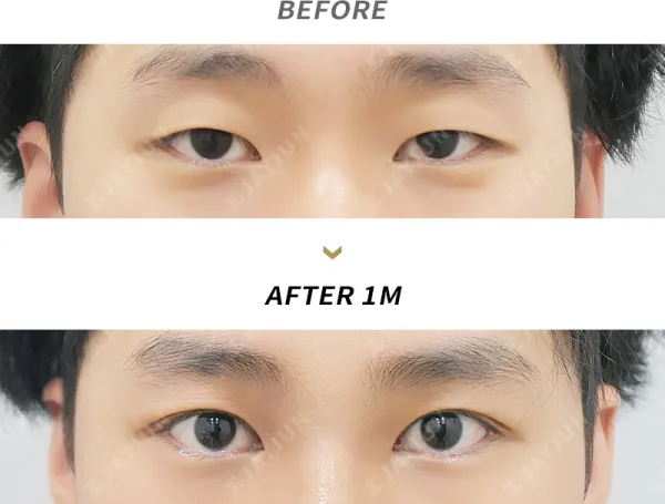 Before/After