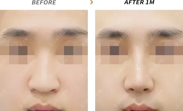 Before/After