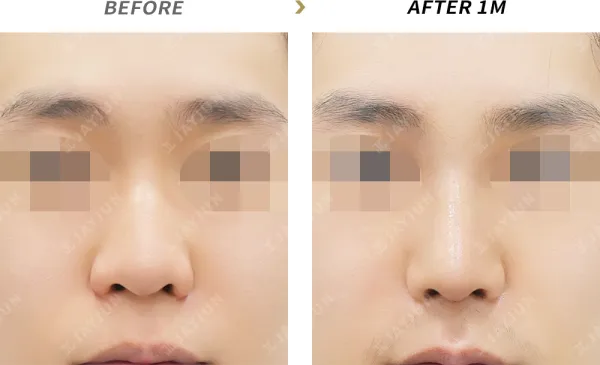Before/After