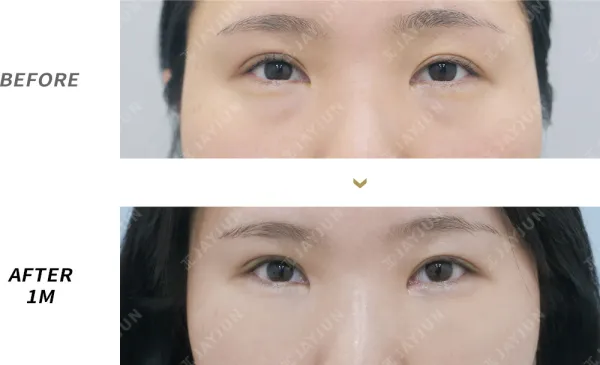 Before/After