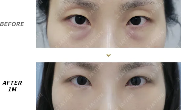 Before/After