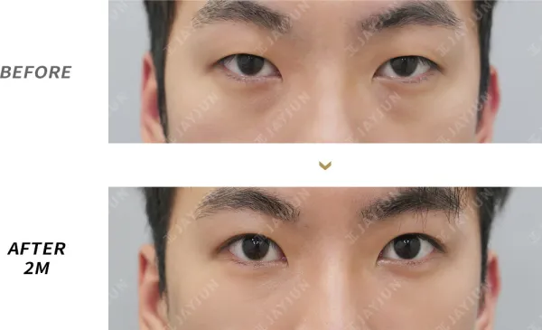 Before/After