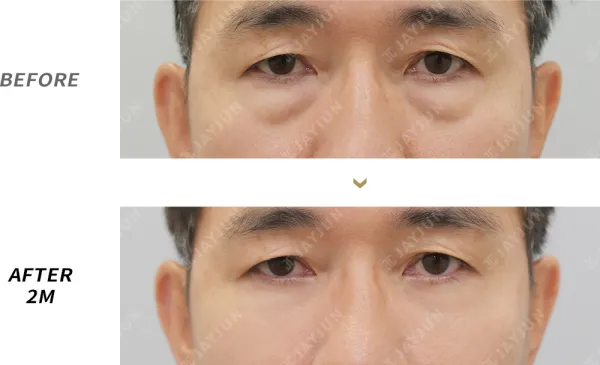 Before/After