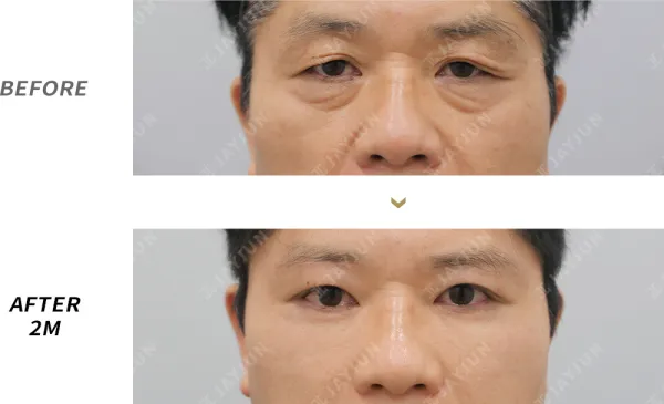 Before/After