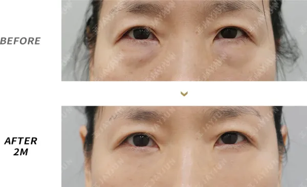 Before/After