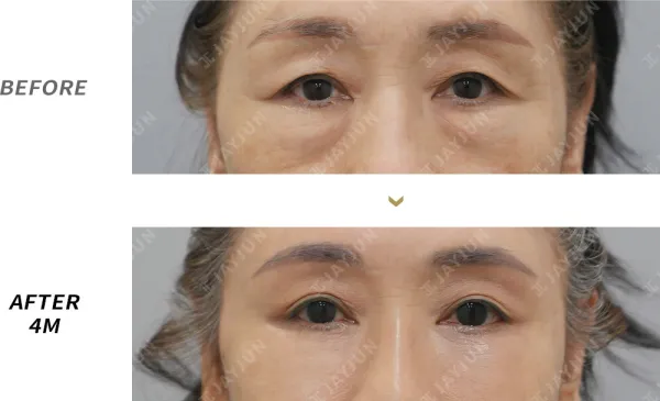 Before/After