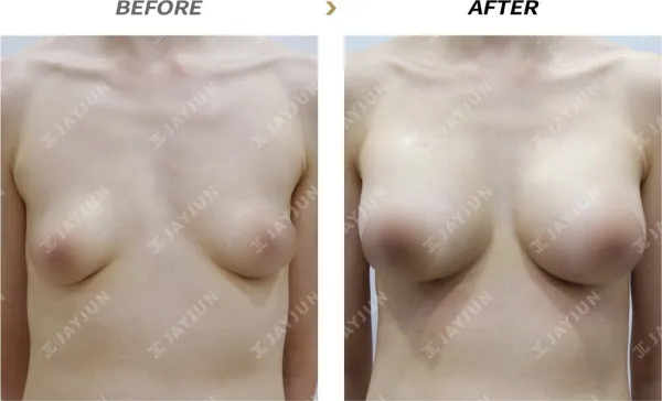 Before/After