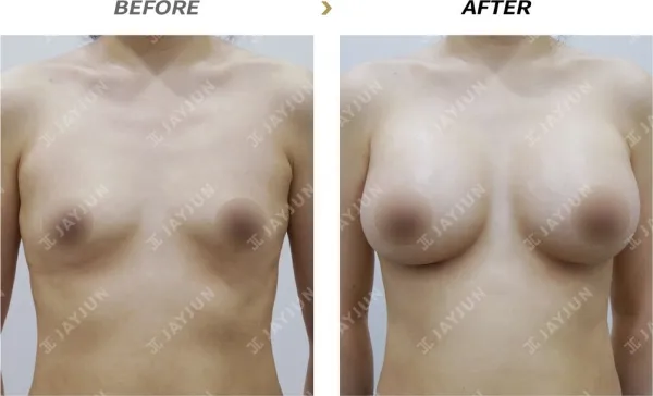 Before/After