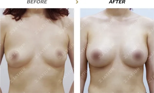 Before/After