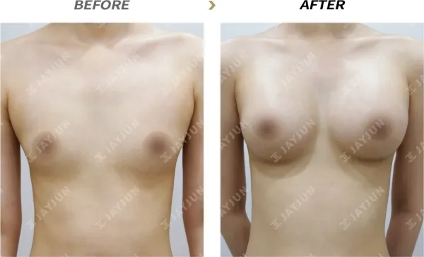 Before/After