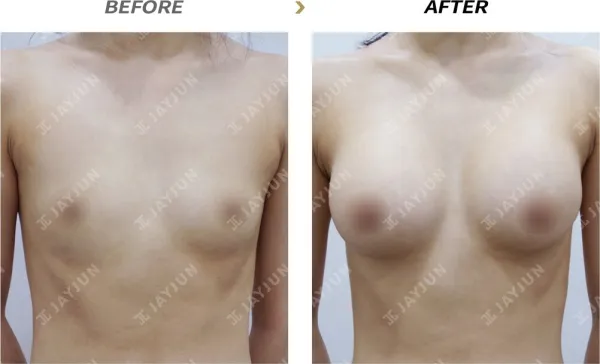 Before/After
