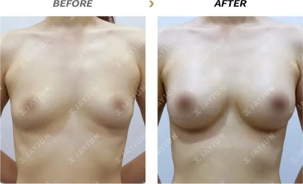 Before/After