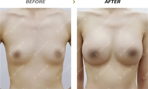Before/After