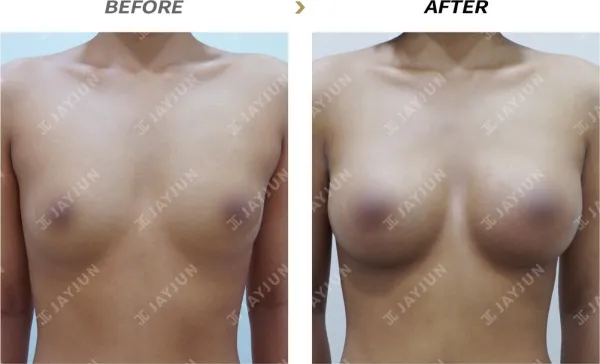 Before/After