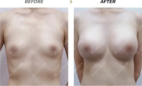 Before/After