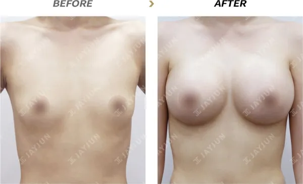 Before/After