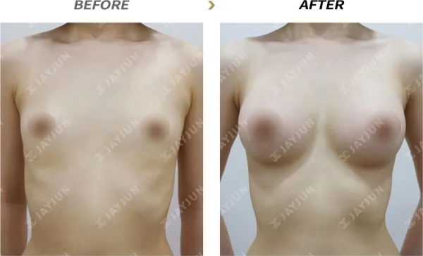Before/After