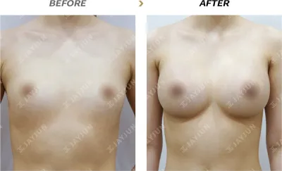 Before & After