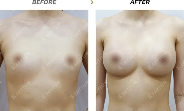 Before/After