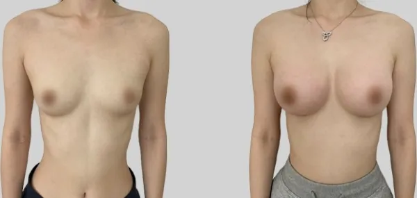 Before/After
