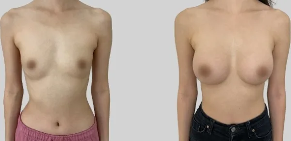 Before/After