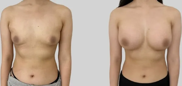 Before/After