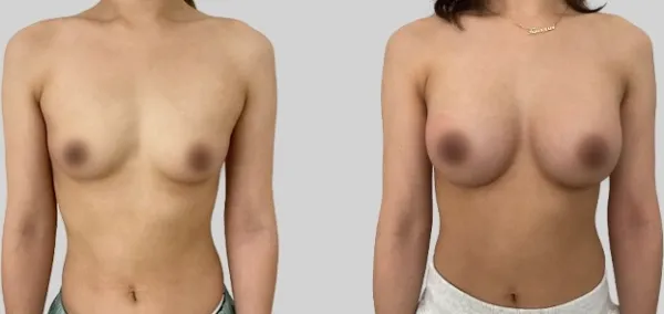 Before/After
