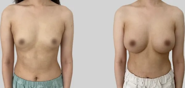 Before/After