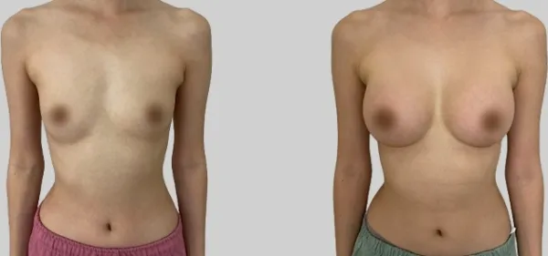 Before/After