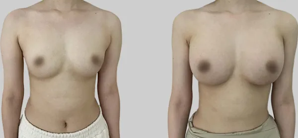 Before/After