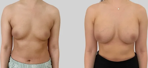 Before/After