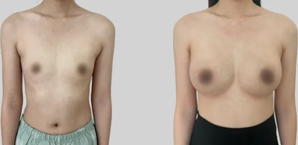 Before/After