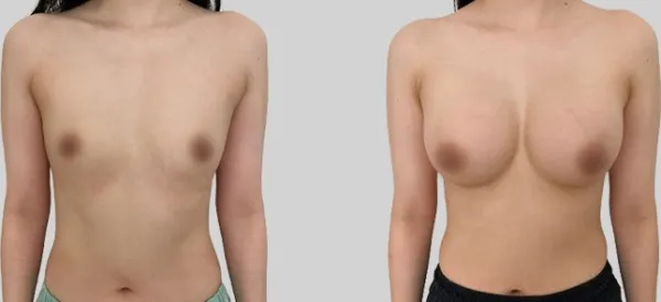 Before/After