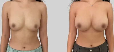 Before & After