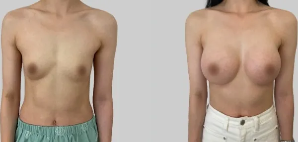 Before/After