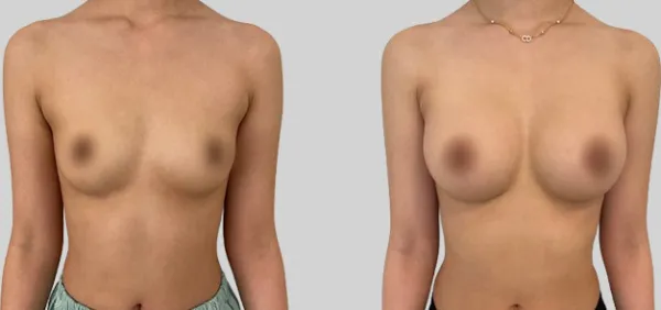 Before/After